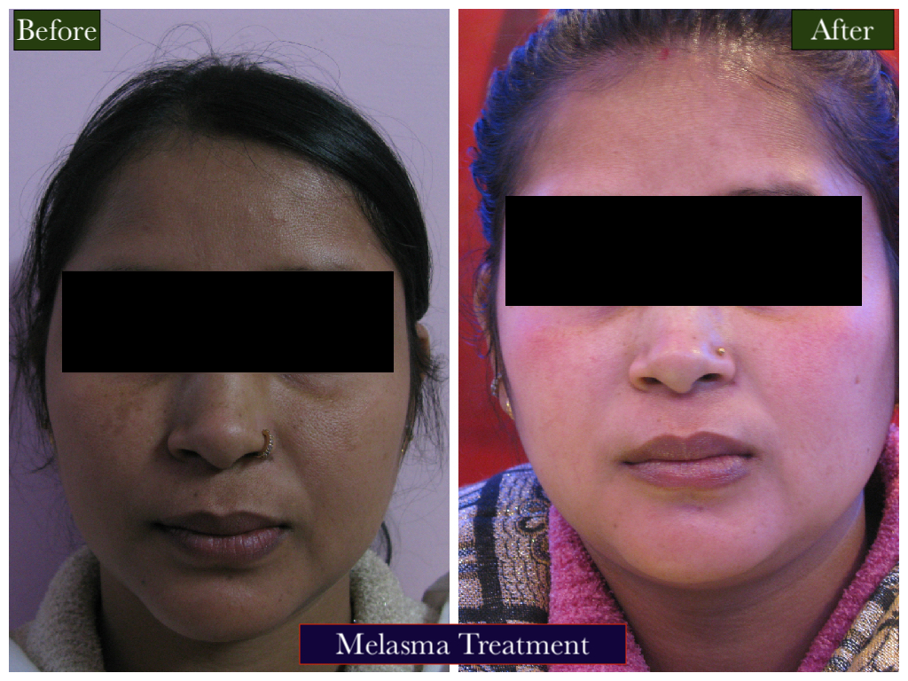 Melasma Treatment